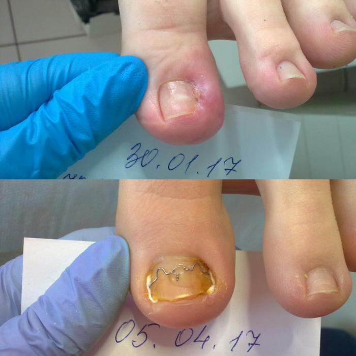 Аппаратный педикюр в Хмельницком - изображениe 2