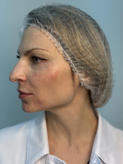 Косметологія Плазмотерапія PRPPPP - изображениe 3