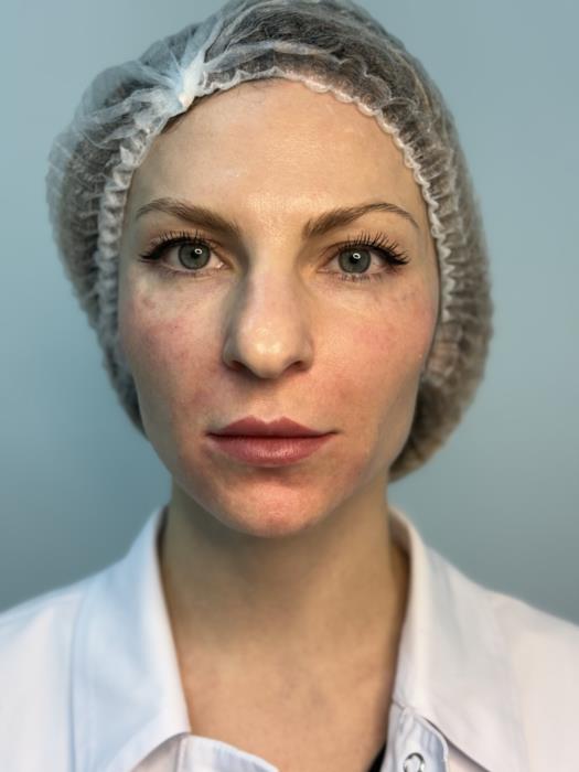 Косметологія Плазмотерапія PRPPPP - изображениe 4